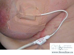 A better way to drain a breast abscess