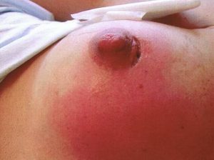 How a breast abscess is drained is important